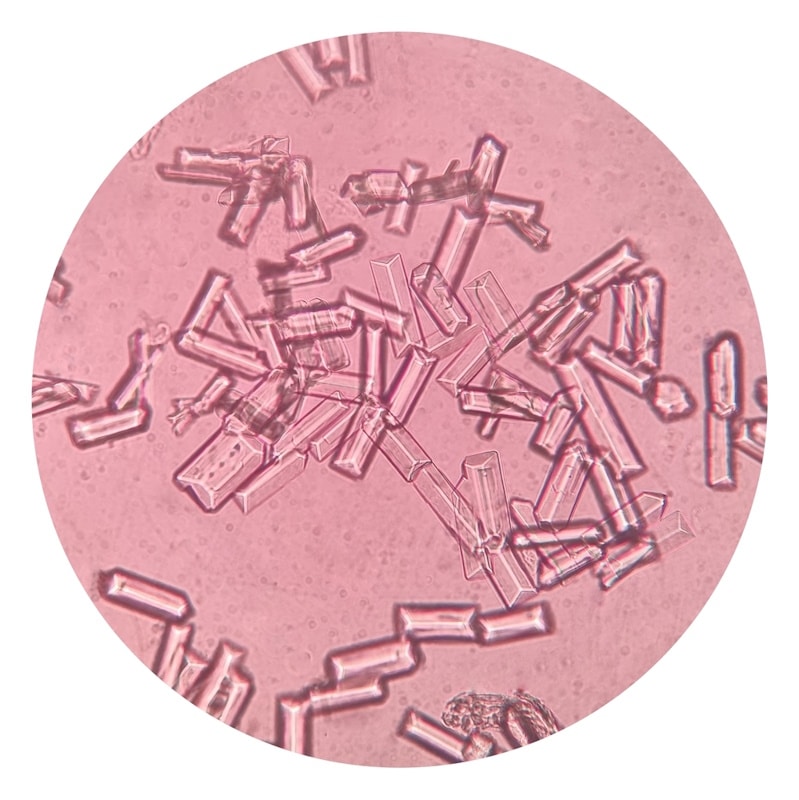 Urine sediment showing Struvite crystals