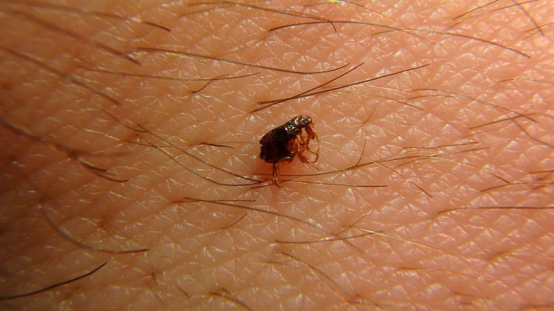 flea on a person's skin