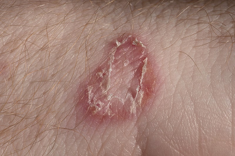 Ringworm on man's skin